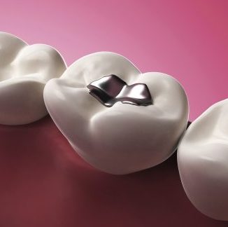 3d rendered illustration of an amalgam filling